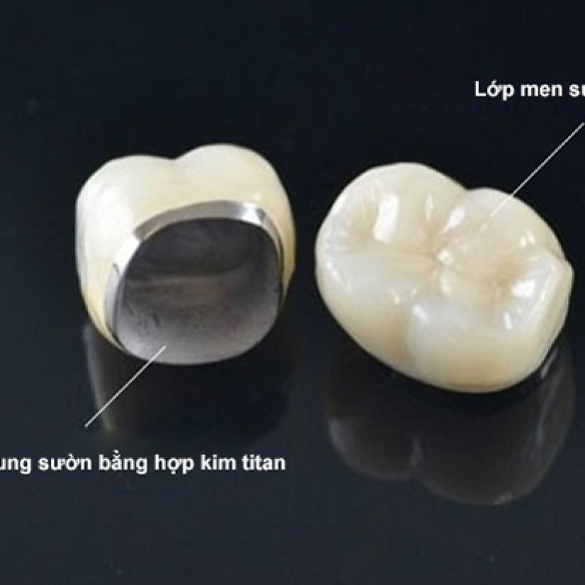 Răng Sứ TiTan