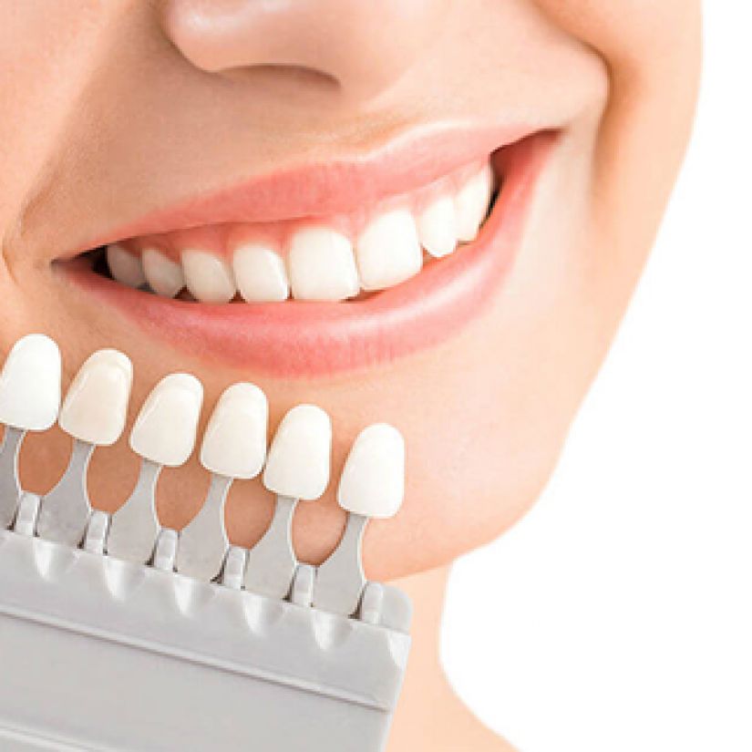 Mặt dán sứ Veneer Emax Press 